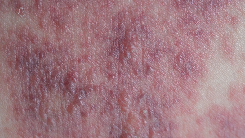 Dermatitis 