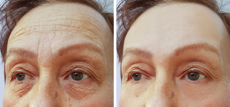 face elderly woman forehead wrinkles before and after cosmetic procedures