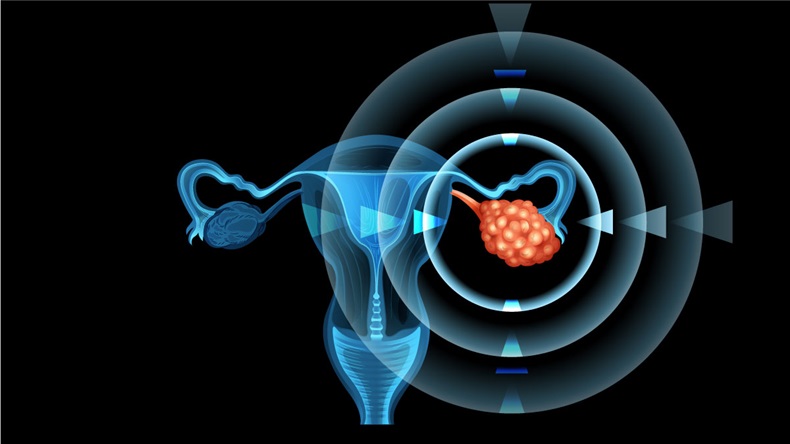 Cancer in ovary of woman illustration