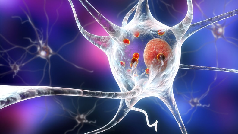 Parkinson's disease. 3D illustration showing neurons containing Lewy bodies small red spheres which are deposits of proteins accumulated in brain cells that cause their progressive degeneration - Illustration 