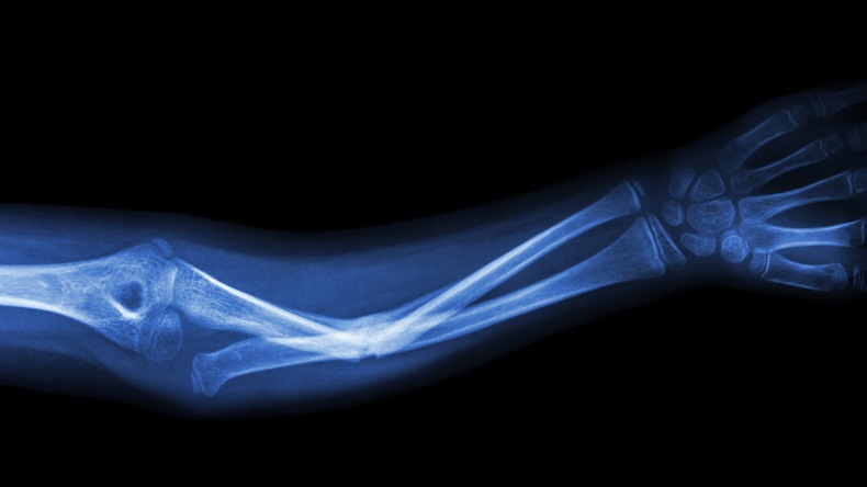 Fractured bone