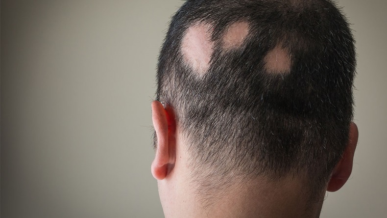 Alopecia Aerata - Image 