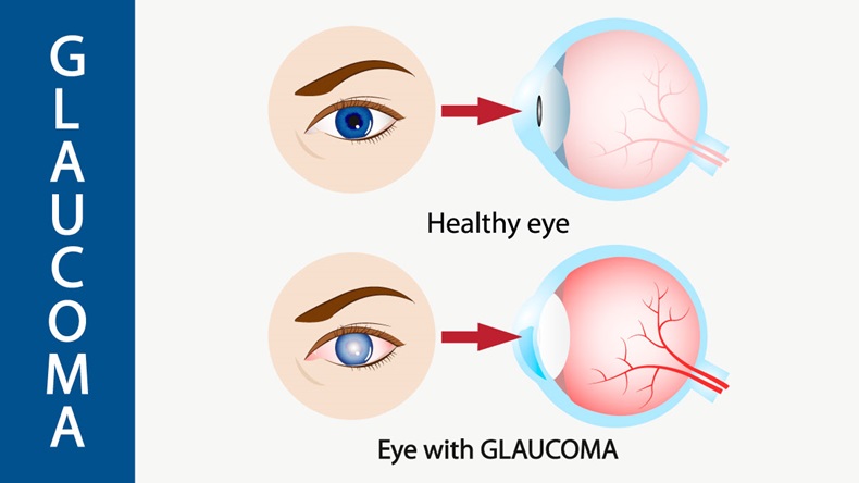 Glaucoma eye, pressure, optic, nerve, blindness, glaucoma, - Vector 