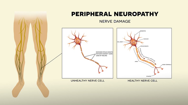 Neuropathy that is the damage of peripheral nerves that causes pain and loss of sensation in the extremities. 