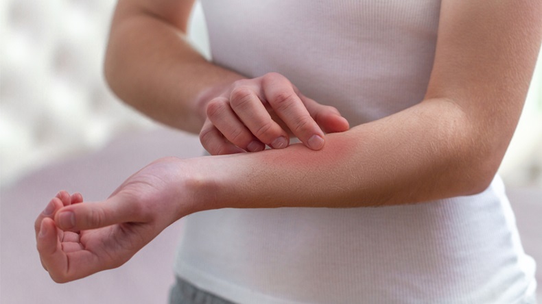 Young woman suffering from itching on her skin and scratching an itchy place. Allergic reaction to insect bites, dermatitis, food, drugs. Health care concept. Allergy rash - Image 