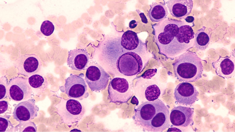 Fine needle aspirate cytology of metastatic melanoma, with large malignant cells. In the center of this photomicrograph is an "intranuclear inclusion" a feature often associated with melanomas. - Image 