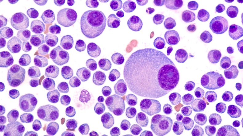 Multiple Myeloma Awareness: Bone marrow aspirate cytology of multiple myeloma, a type of bone marrow cancer of malignant plasma cells, associated with bone pain, bone fractures and anemia. - Image 