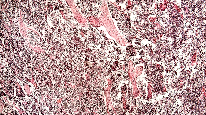 Small-cell lung cancer of a human, photomicrograph panorama as seen under the microscope, 50x zoom. - Image 