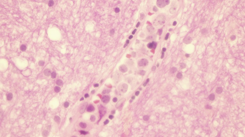 Intravascular non Hodgkins lymphoma - Image 