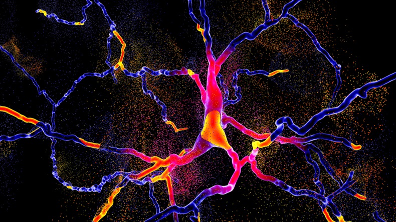 Degeneration of dopaminergic neuron, a key stage of development of Parkinson's disease, 3D illustration