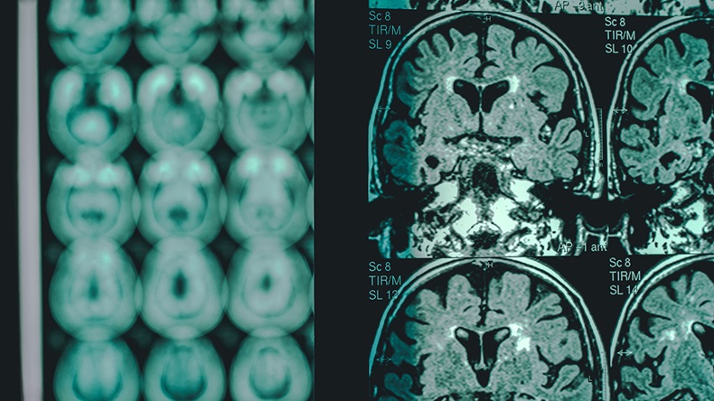Alzheimer's disease on MRI