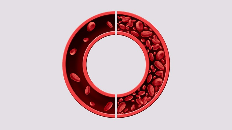 Anemia medical diagram concept as normal and abnormal blood cell count and human circulation in an artery or vein as a 3D illustration isolated on a white background.