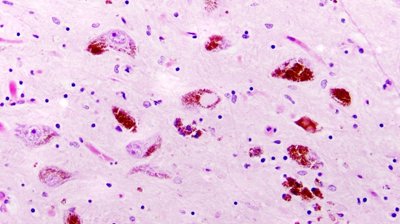 Parkinson's disease, substantia nigra, Lewy bodies.