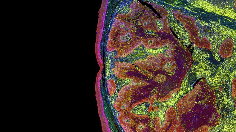 Multicolor image of tumor cells under microscope
