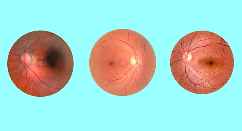 View inside human eye disorders - showing retina, optic nerve and macula.