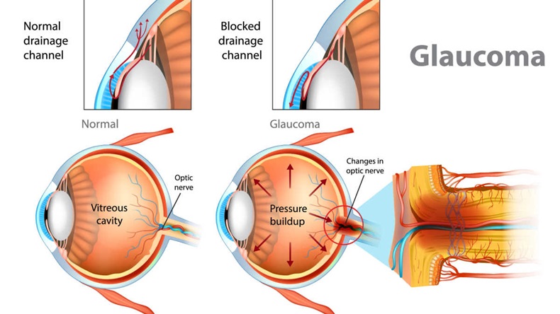 Glaucoma model