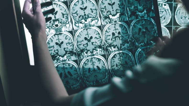 Alzheimer's disease on MRI