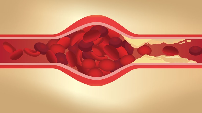 Arteries swelling because blood clot by fat cloged made blood flow slowly. Illustration about danger of Cholesterol.