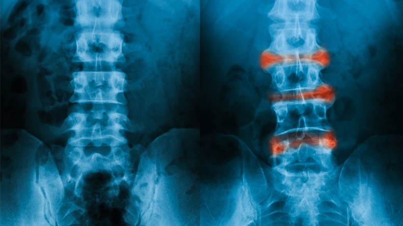 L-S spine X-ray image, AP view, comparison between normal and ankylosing spondylitis lumbar