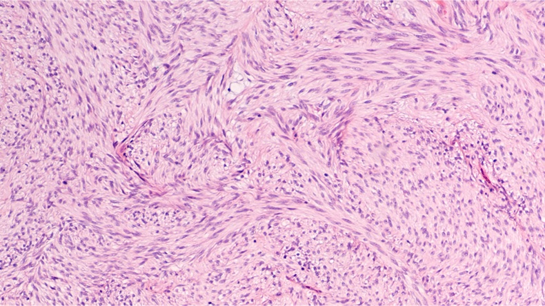 Microscopic image of a gastrointestinal stromal tumor (GIST). Malignant potential depends on size, location and mitotic activity. Targeted therapy with Imatinib (Gleevec) may prevent recurrence. - Image 