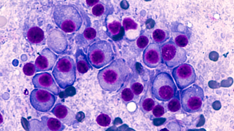 Multiple Myeloma Awareness: Bone marrow aspirate cytology of multiple myeloma, a type of bone marrow cancer of malignant plasma cells, associated with bone pain, bone fractures and anemia.