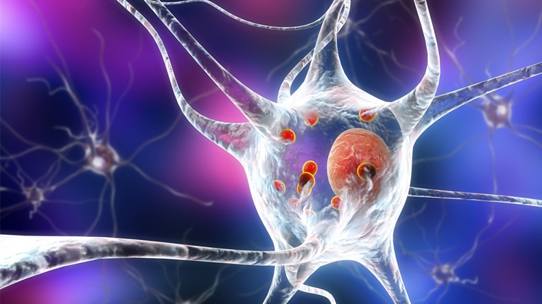 Parkinson's disease. 3D illustration showing neurons containing Lewy bodies small red spheres which are deposits of proteins accumulated in brain cells that cause their progressive degeneration - Illustration