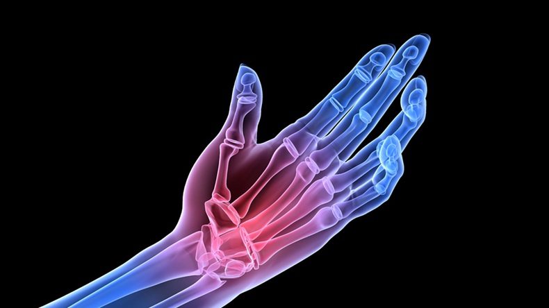 x-ray hands, rheumatoid arthritis