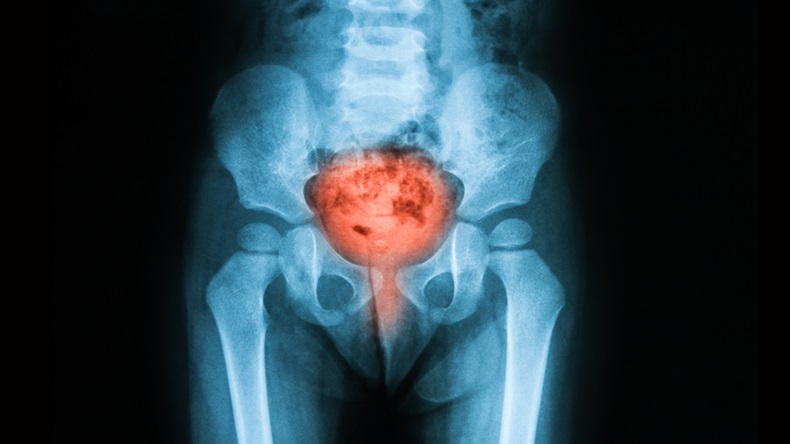 X-ray image of bladder, Showing cystitis or lower urinary tract infection