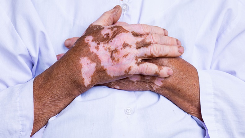 Vitiligo on the hands. Shutterstock 1621981522